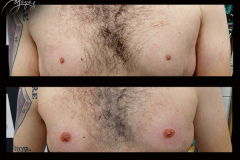 mickael-areoles